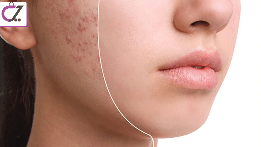 چگونه مانع از جوش و براق شدن پوست شویم؟