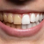 خمیر دندان سفید کننده فورامن مدل Whitening وزن 125 گرم - Image 2