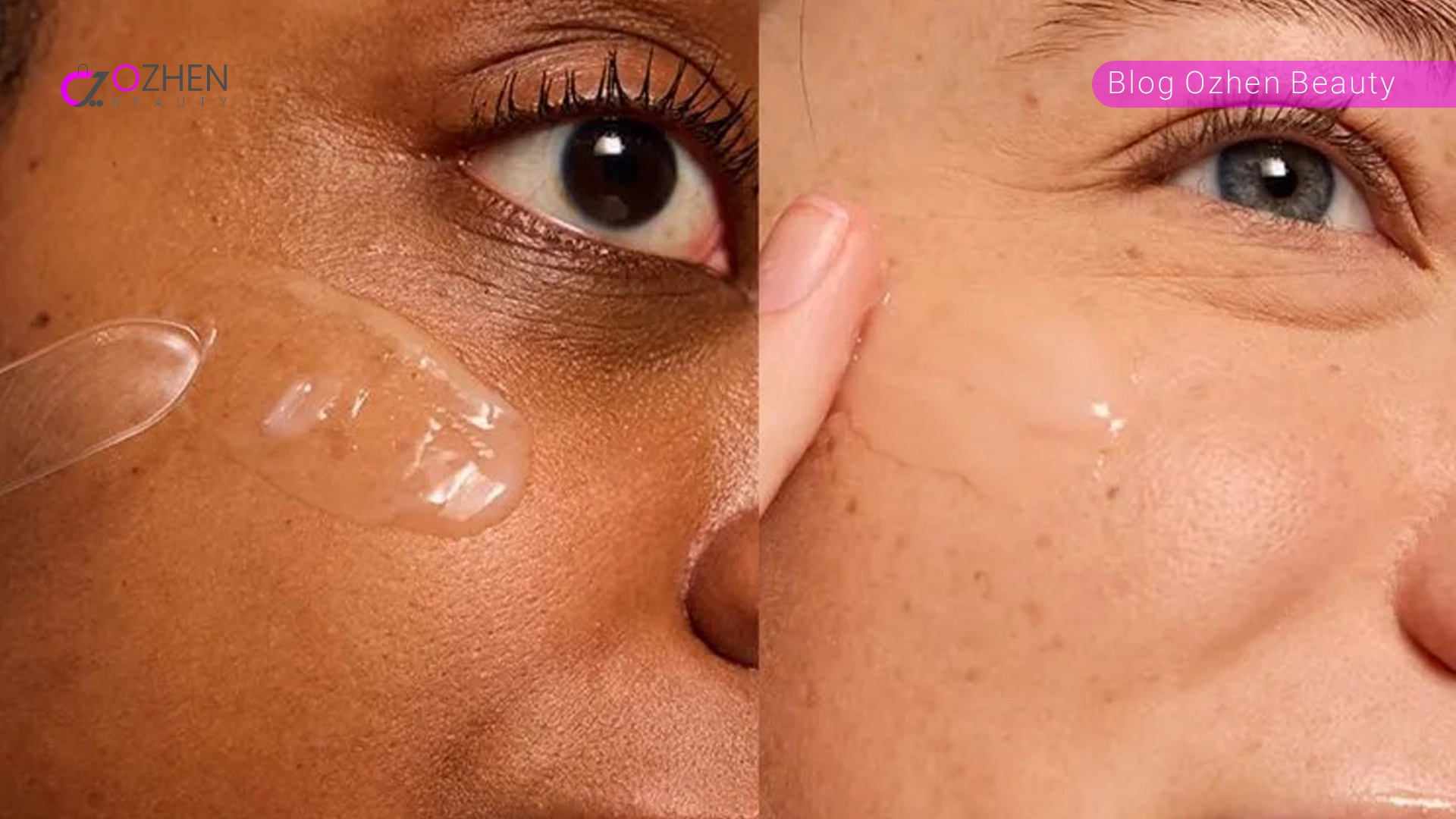 کرم آبرسان چه تأثیری بر لک صورت دارد؟