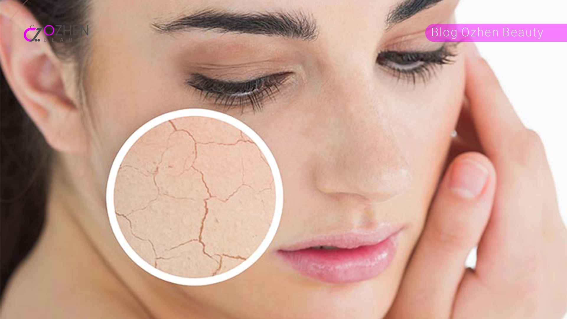 پوست خشک چه نوع پوستی است؟