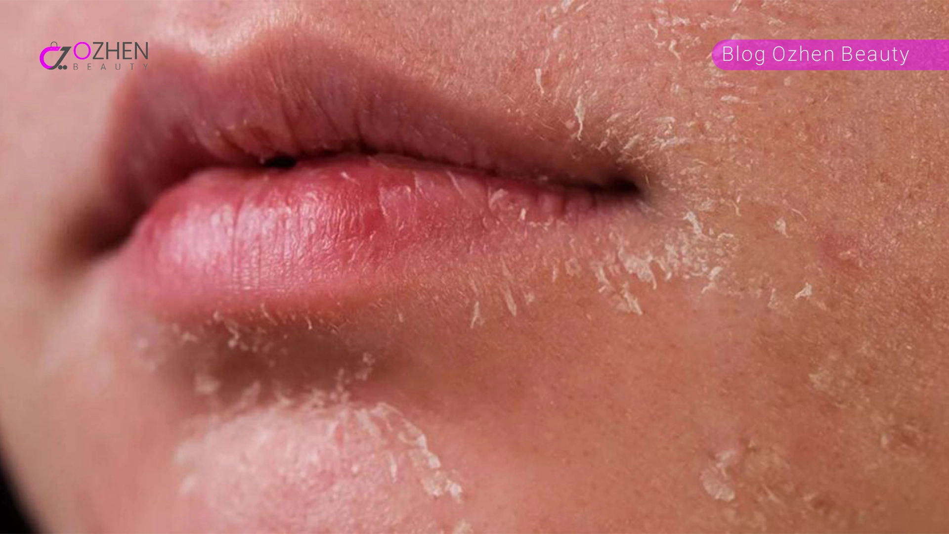 پوست خشک چه نوع پوستی است؟