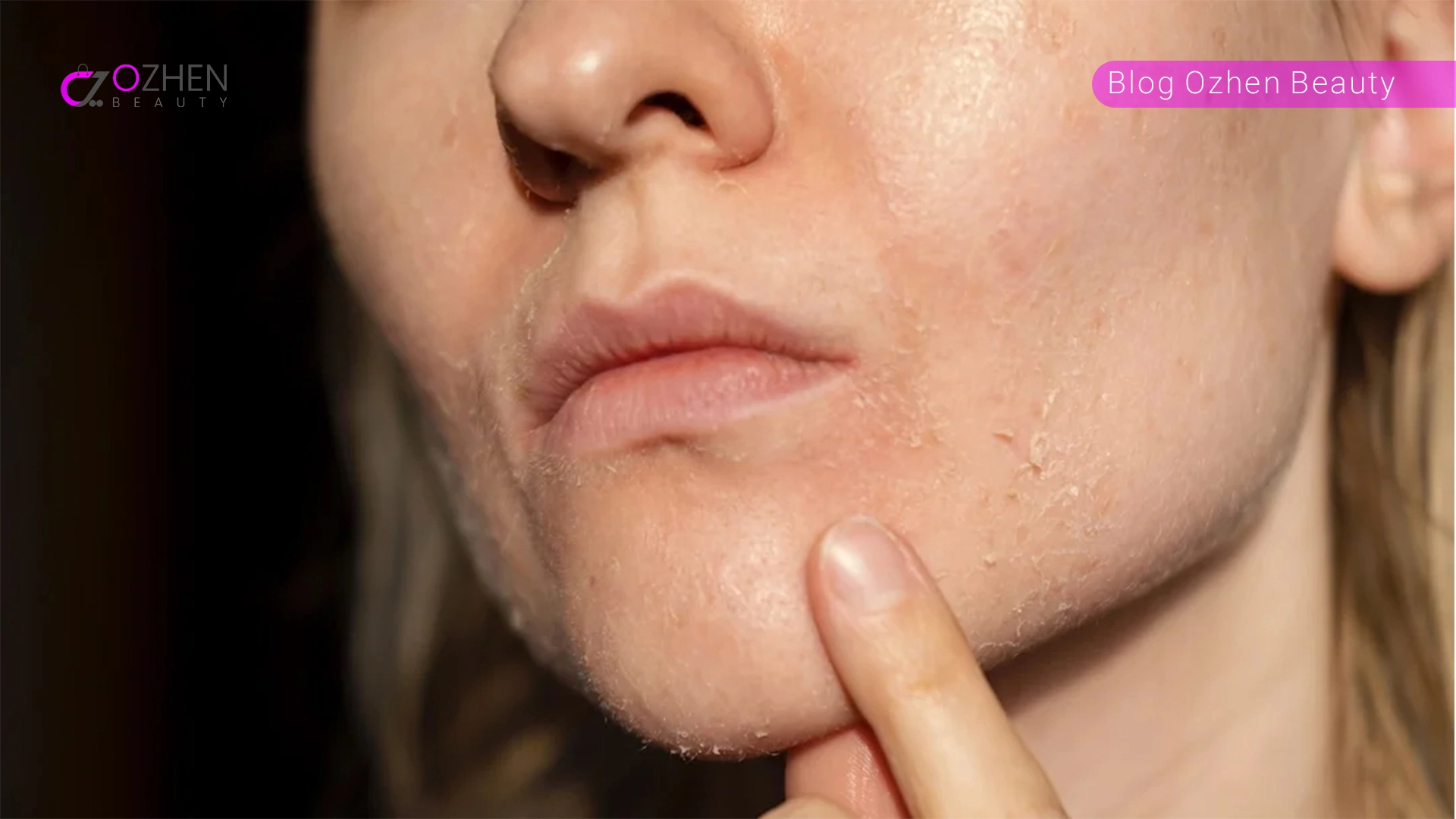 پوست خشک چه نوع پوستی است؟