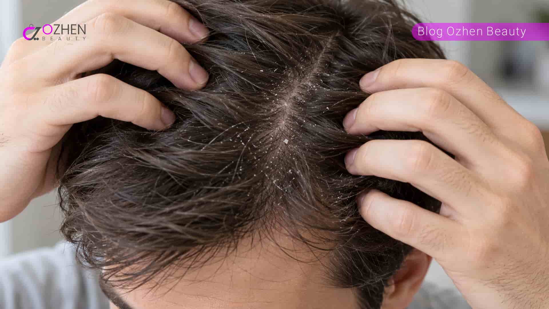 تفاوت شوره خشک و شوره چرب چیست؟