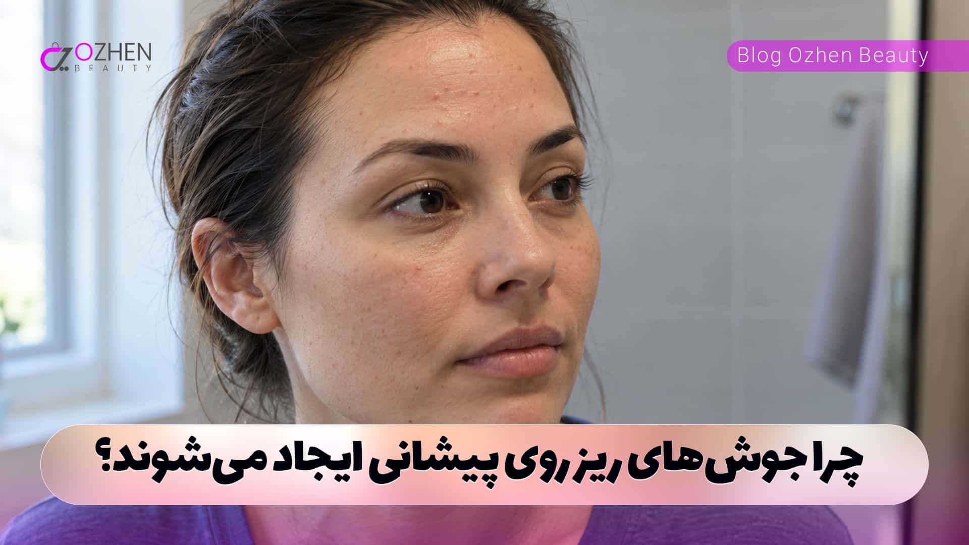 چرا جوش‌های ریز روی پیشانی ایجاد می‌شوند؟