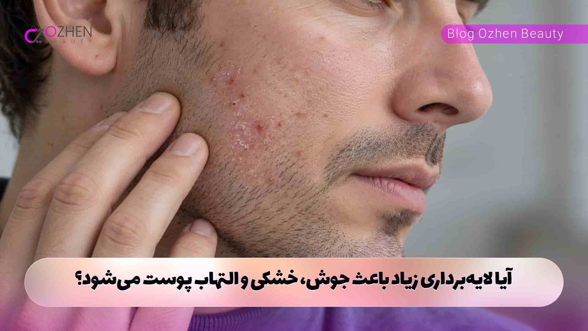 آیا لایه‌برداری زیاد باعث جوش، خشکی و التهاب پوست می‌شود؟